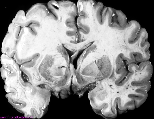 Malignant cerebral edema secondary to traumatic head injury